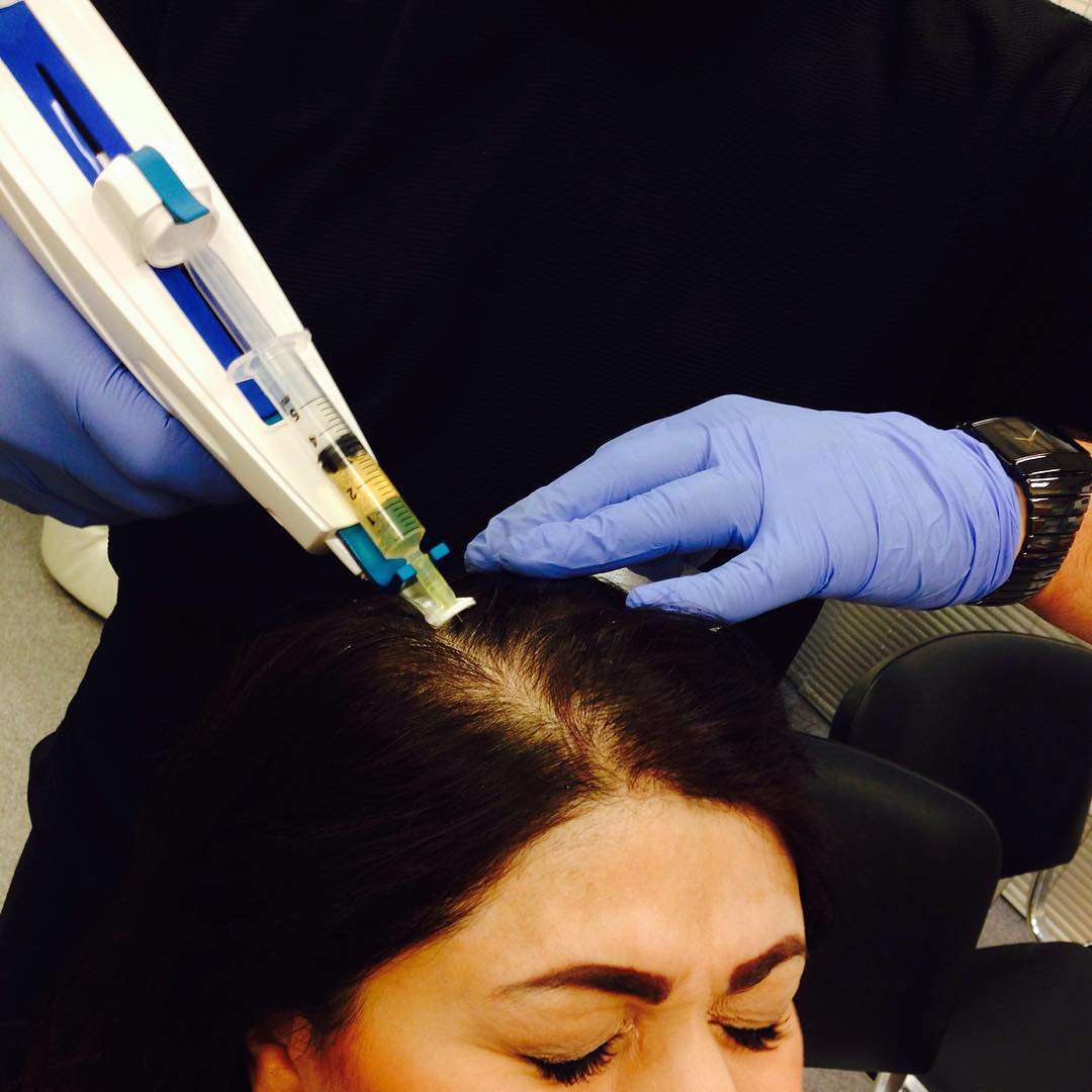 Collection 100+ Pictures Mesotherapy For Hair Before And After Pictures ...